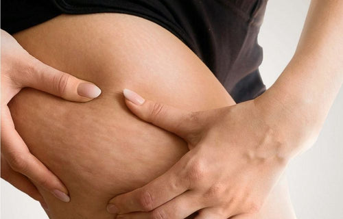 Tūska vai celulīts: ceļvedis ceļā uz veselīgu un skaistu ķermeni